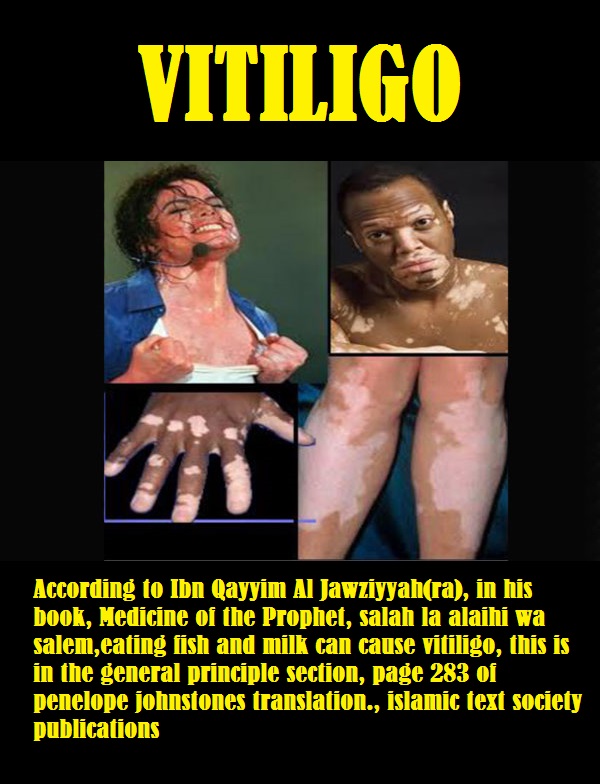 vitiligo2