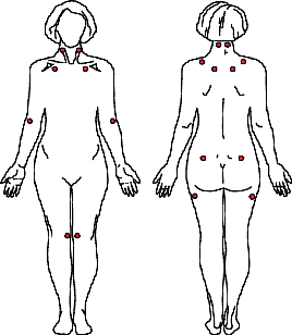 tenderpoints fibro